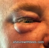 Honeybee sting on my eye